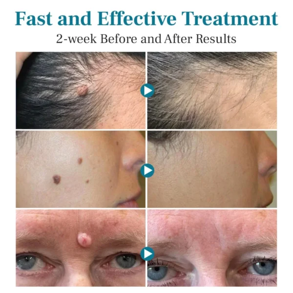 LAOZIK™ FlawZapper Mole and Wart Removal Laser Pen - Image 3