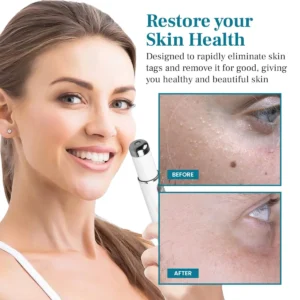 LAOZIK™ FlawZapper Mole and Wart Removal Laser Pen