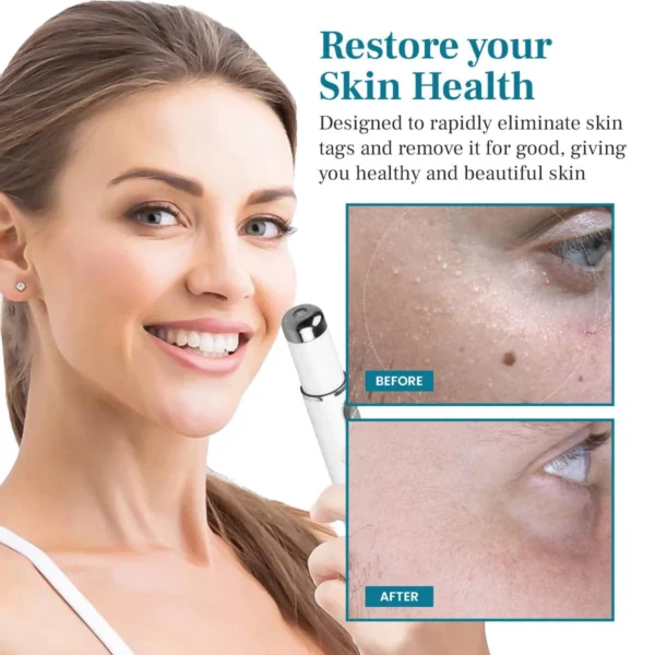 LAOZIK™ FlawZapper Mole and Wart Removal Laser Pen