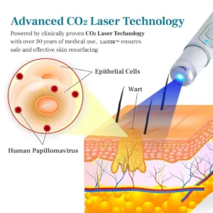 LAOZIK™ FlawZapper Mole and Wart Removal Laser Pen