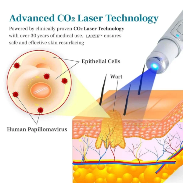 LAOZIK™ FlawZapper Mole and Wart Removal Laser Pen