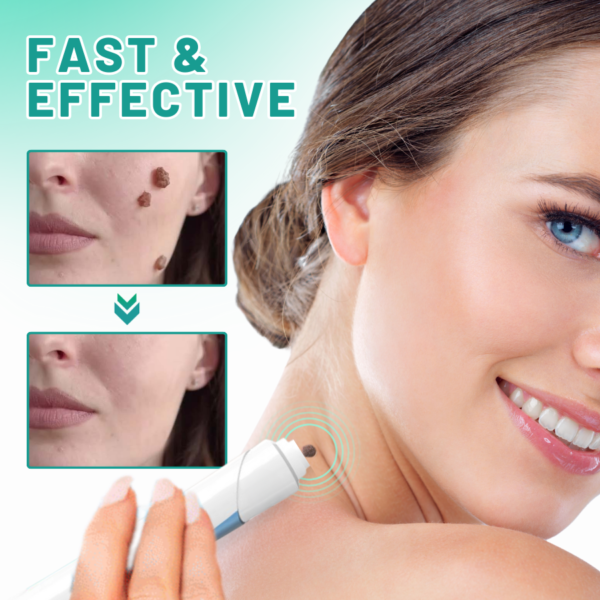 LAOZIK™ 2-in1 Skin Tag Removal Kit - Image 4