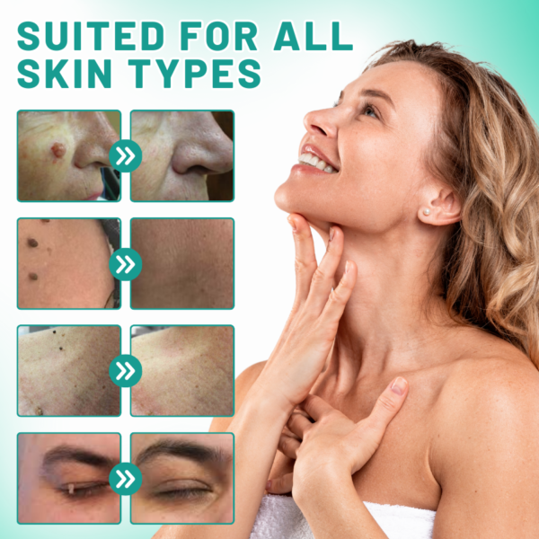 LAOZIK™ 2-in1 Skin Tag Removal Kit - Image 2