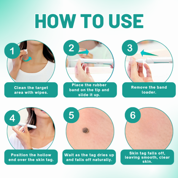 LAOZIK™ 2-in1 Skin Tag Removal Kit - Image 5
