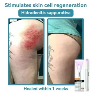 Alternative view of LAOZIK™ All-in-One CO₂ Laser Eraser Pen