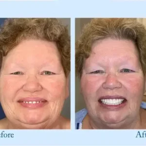 TrueEase™ Dentures