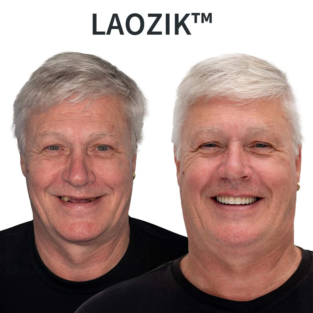 🦷 LAOZIKTM Custom-Fit Dentures ⏰ ENDS TODAY 70% OFF | Smile with Confidence